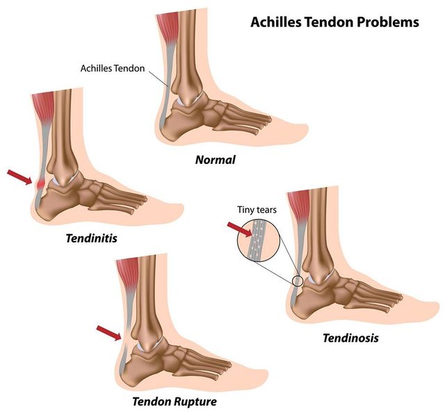 Achilles tendon hot sale attachment pain